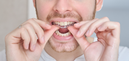 orthodontie invisible aligneurs transparents Bruxelles