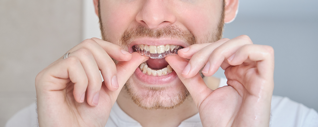 orthodontie invisible aligneurs transparents Bruxelles